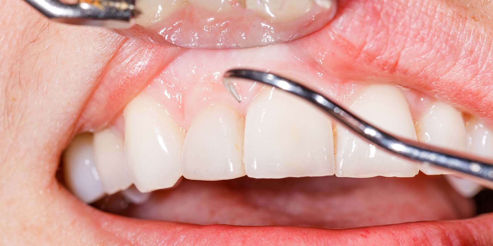 歯周病と抜歯